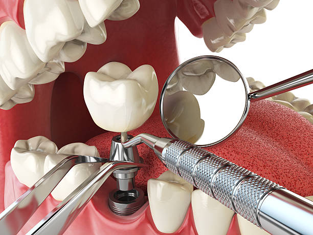 Best Broken or Cracked Tooth Emergency Dentist in Grover, WY